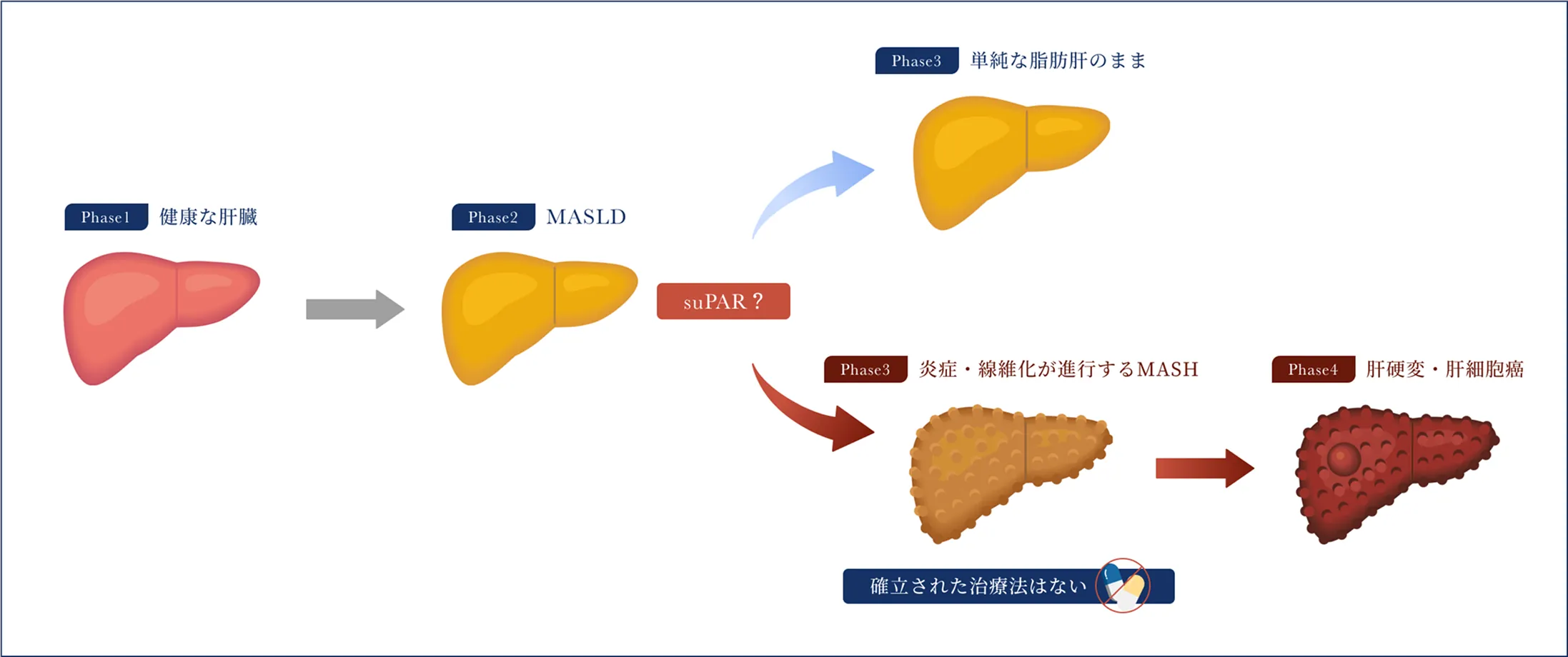 代謝機能障害関連脂肪性肝疾患(MASLD)における肝線維化病態の運命分岐点の解明